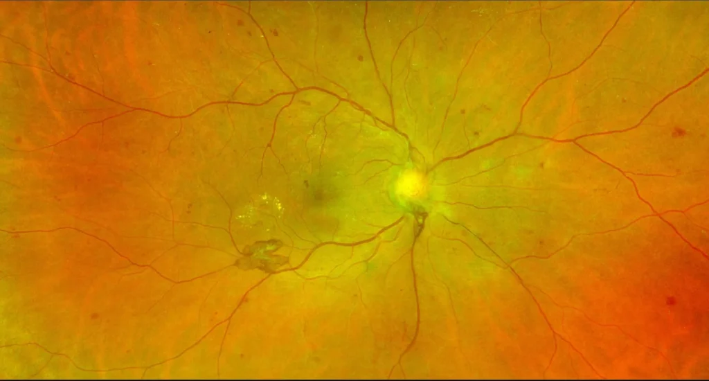 Diabetic retinopathy home page image 2 scaled.jpg ITR