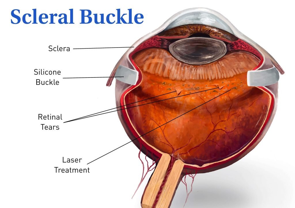 Diagram of the eye labeled with its parts, including the retina, from Retina Hospital in Indore.