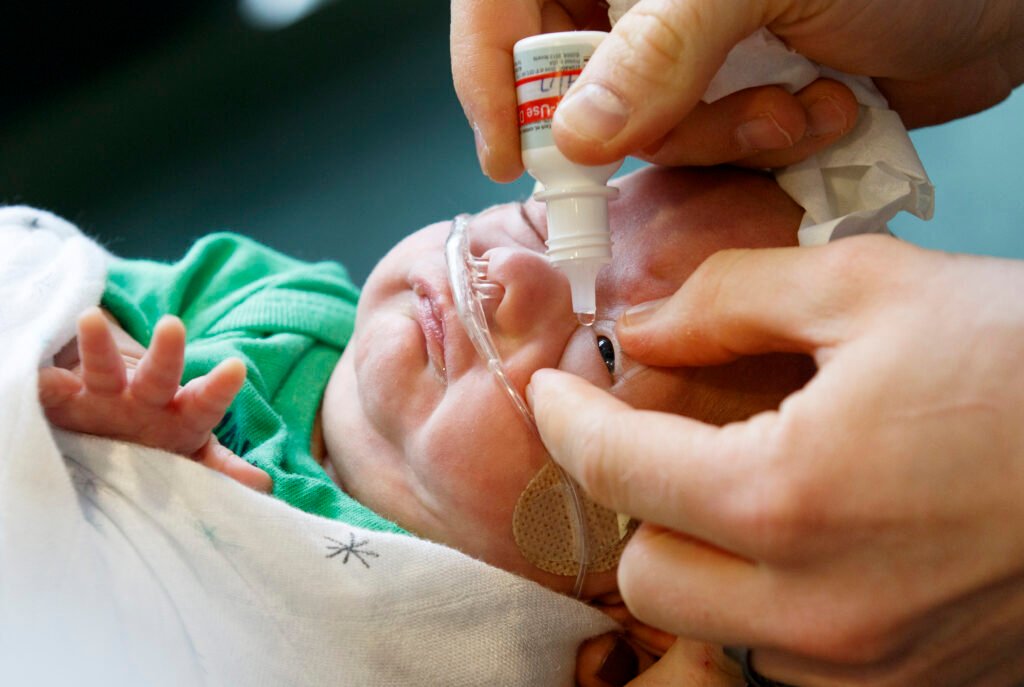 Follow-up eye examination for Retinopathy of Prematurity (ROP) in a premature baby by a retina specialist.