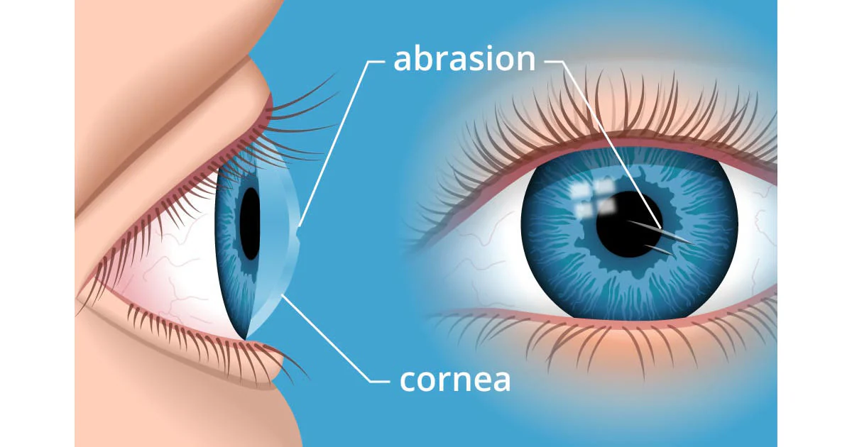 What Are the Most Common Cornea Eye Problems?