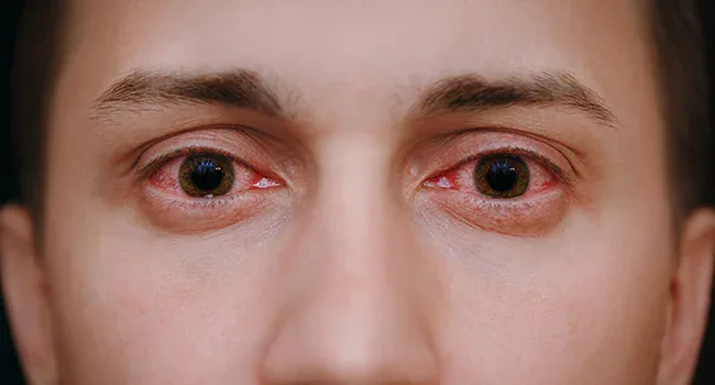Red eyes after shower causes and treatment tips for quick relief