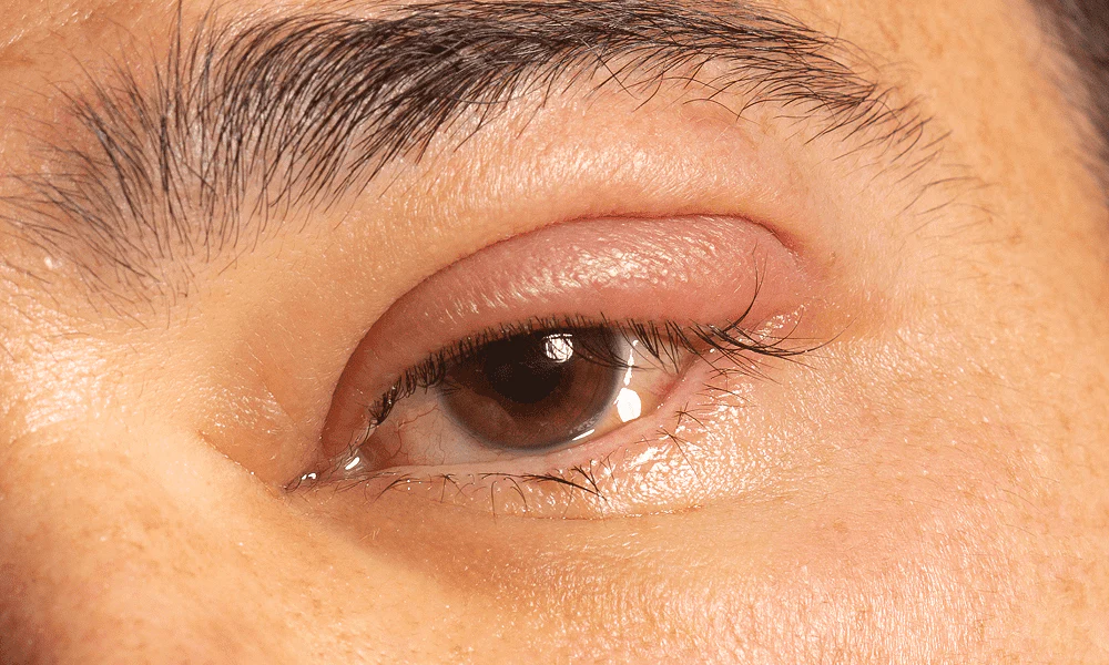 How to Treat and Reduce Swollen Eyes