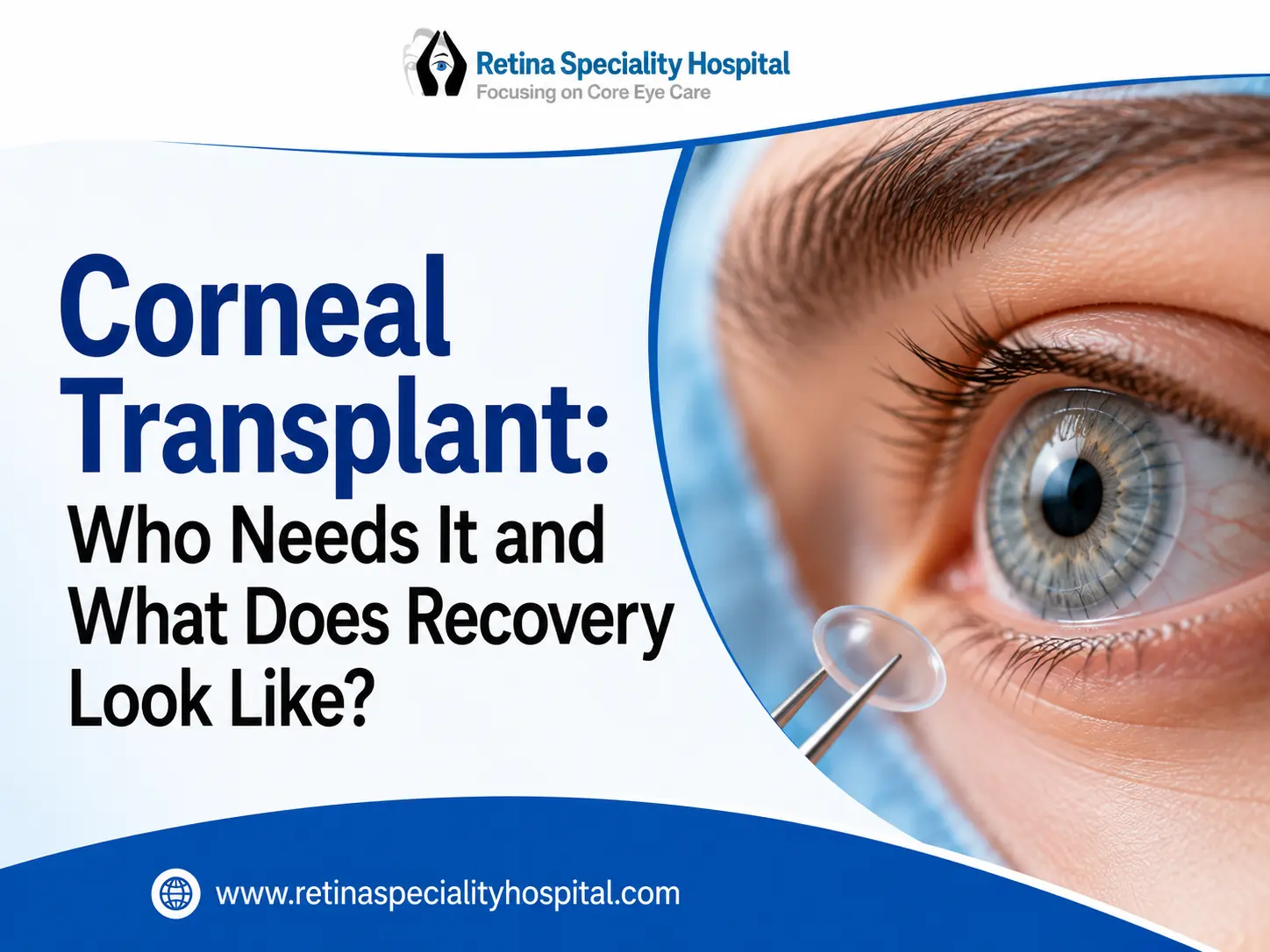 Corneal Transplant: Who Needs It and What Does Recovery Look Like?