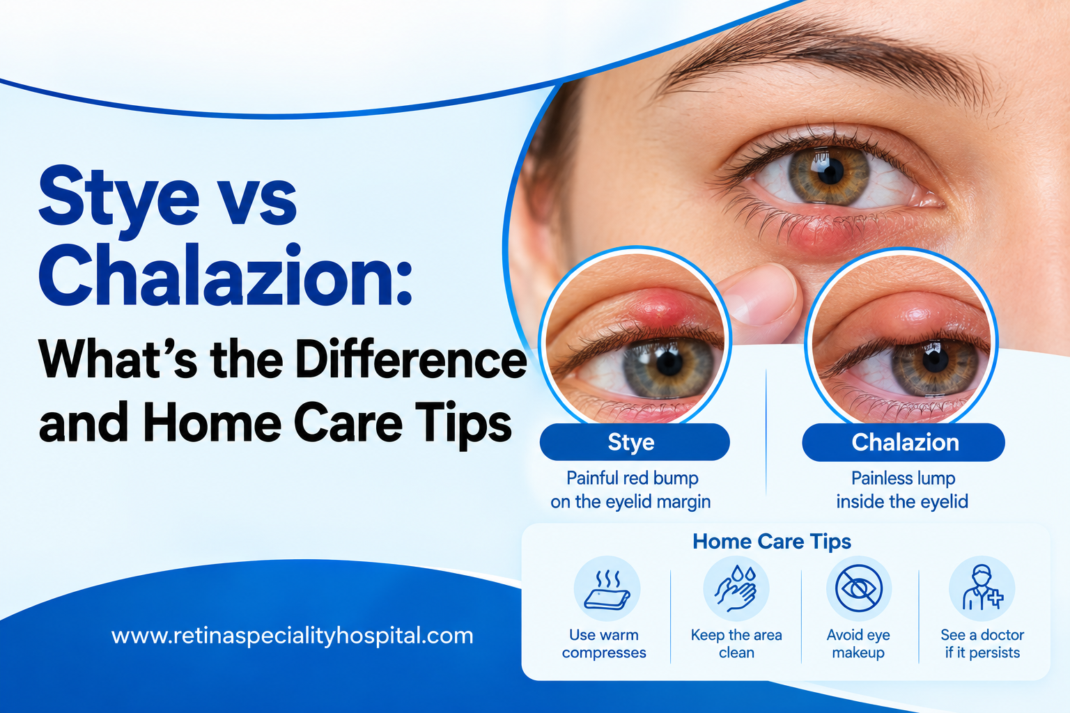 Stye vs Chalazion: What’s the Difference and Home Care Tips